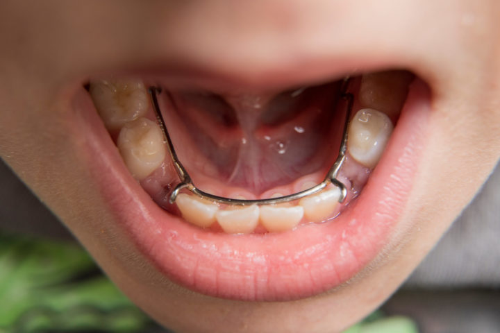 view inside a child's mouth using a space maintainer - Yukon Kids Dental